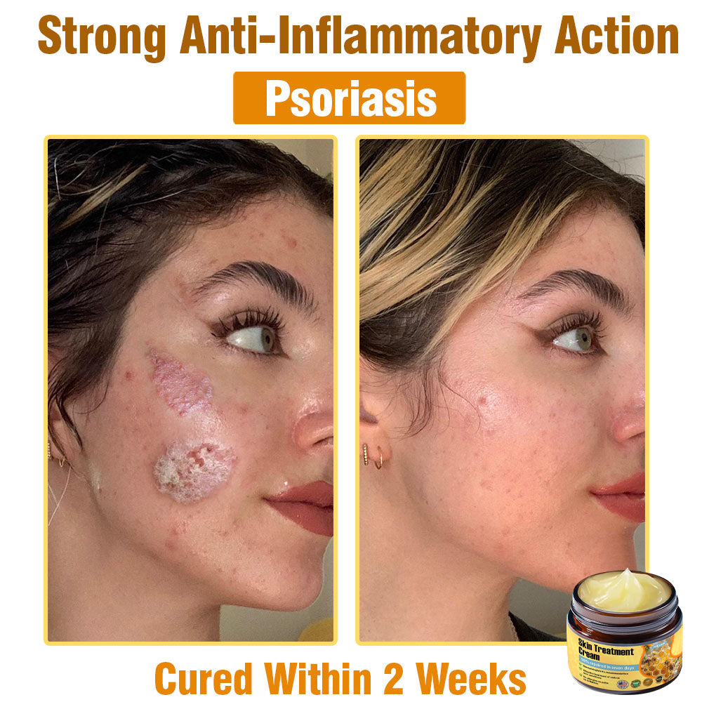 ✅Official Store TF02: 7-Day Multi-Effect All-in-One Skincare Cream (👨‍⚕️AAD Recommended🌼)Psoriasis (fast itch relief and skin repair)