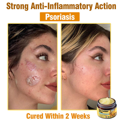 ✅Official Store TF02: 7-Day Multi-Effect All-in-One Skincare Cream (👨‍⚕️AAD Recommended🌼)Psoriasis (fast itch relief and skin repair)