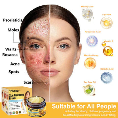 ✅Official Store TF02: 7-Day Multi-Effect All-in-One Skincare Cream (👨‍⚕️AAD Recommended🌼)Psoriasis (fast itch relief and skin repair)