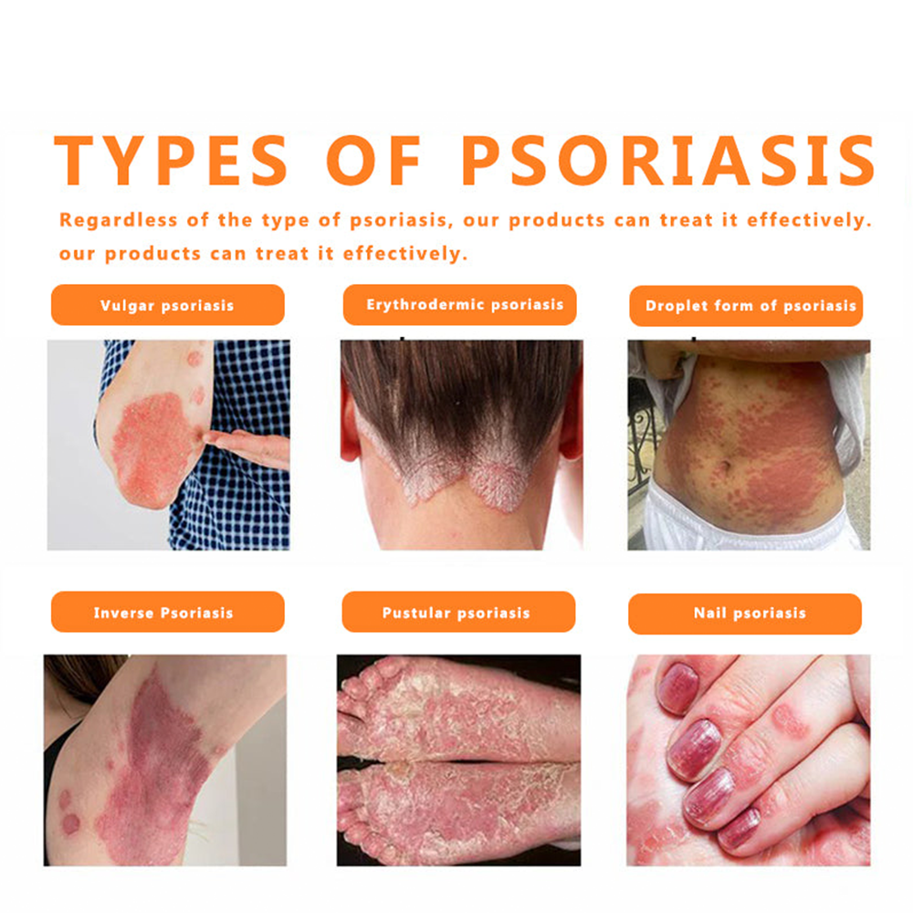 ✅Official Store TF02: 7-Day Multi-Effect All-in-One Skincare Cream (👨‍⚕️AAD Recommended🌼)Psoriasis (fast itch relief and skin repair)