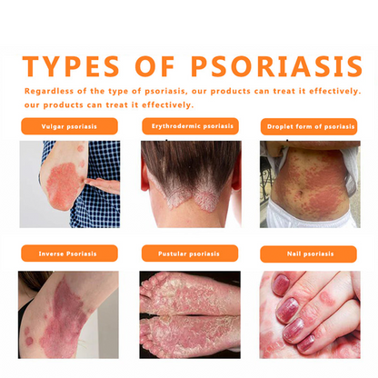 ✅Official Store TF02: 7-Day Multi-Effect All-in-One Skincare Cream (👨‍⚕️AAD Recommended🌼)Psoriasis (fast itch relief and skin repair)